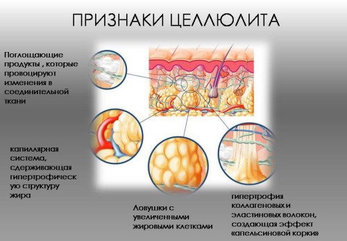Признаки целюлита